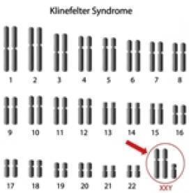 سندرم کلاین فلتر: بیماری کروموزومی در مردان